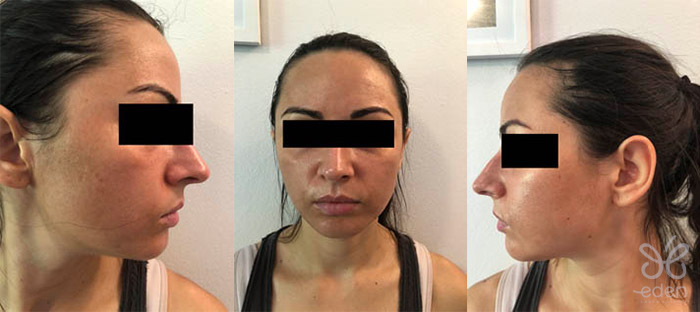Cosmelan treatment 7 days after