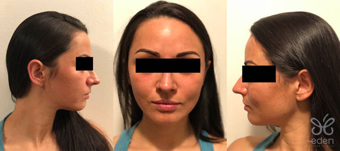 Cosmelan treatment 8 days after