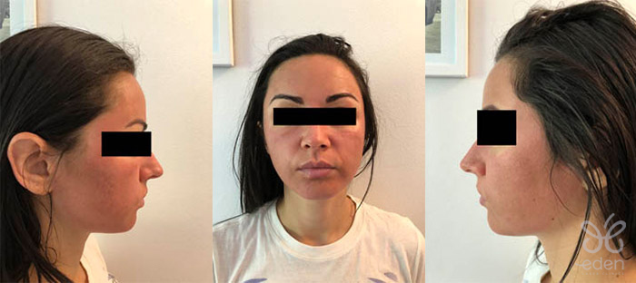 Cosmelan treatment 1 day after