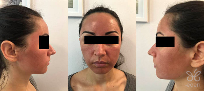 Cosmelan treatment 2 days after