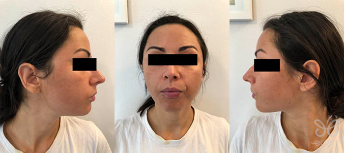 Cosmelan treatment 4 days after