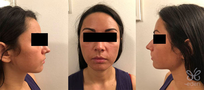 Cosmelan treatment 5 days after