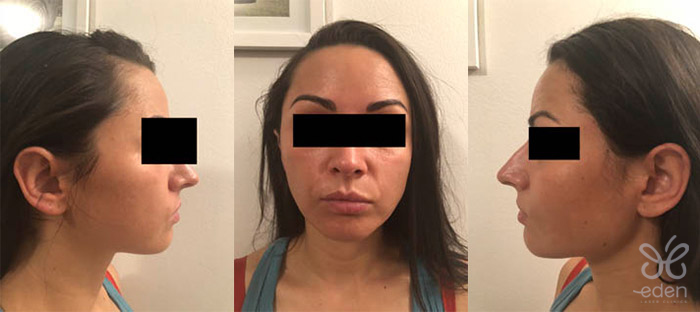 Cosmelan treatment 6 days after