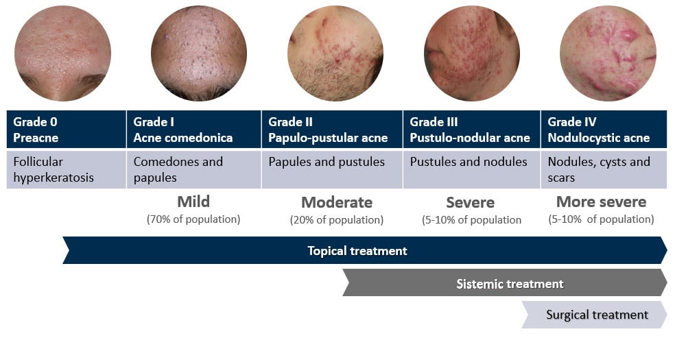 Acne classification - lesion type