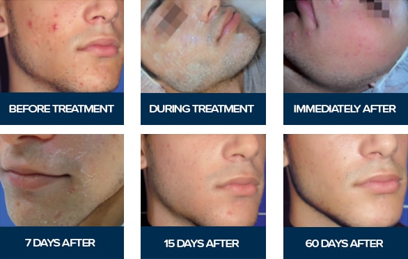Acnelan acne treatment before-&-after photos