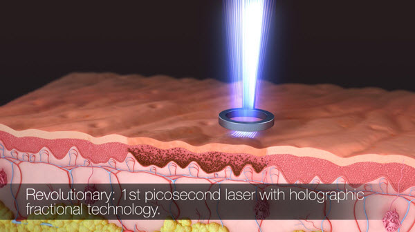 The first picosecond laser with holographic fractional technology