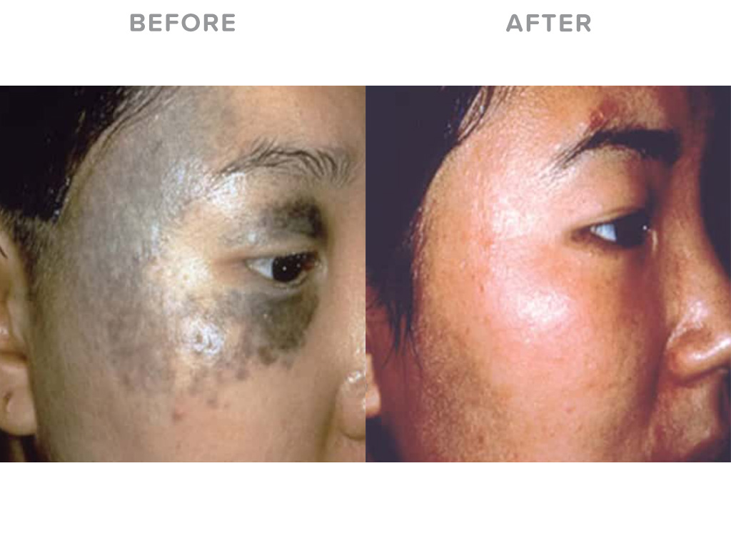 Pigmentation Removal With Picoway Eden Laser Clinics