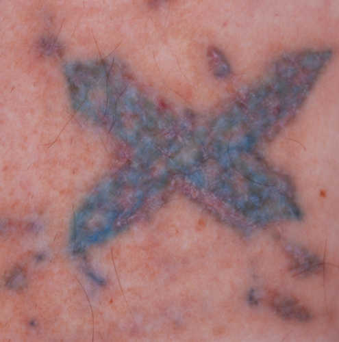 Laser Tattoo Removal Sydney - Eden Laser Clinics